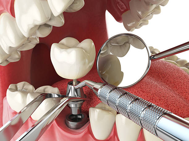 Best Emergency Dental Care for Broken or Chipped Teeth in Norwalk, CA