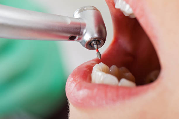 Best Emergency Tooth Extraction in Norwalk, CA
